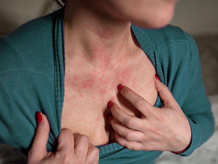 What Causes Hives? - Sharecare