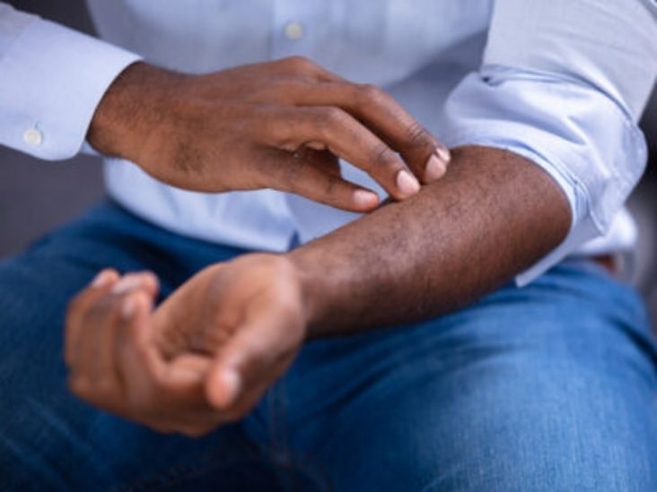 Why Does Psoriasis Itch and How to Stop It