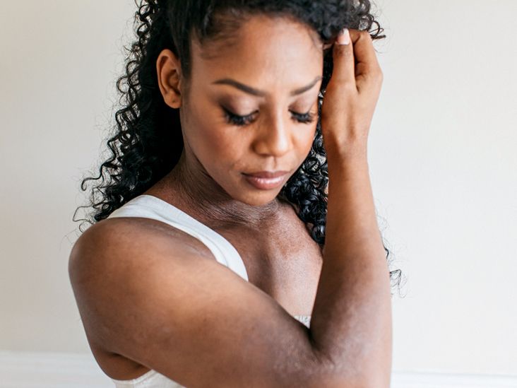 How to Tell It's Time to Switch Treatment for Your Severe Eczema