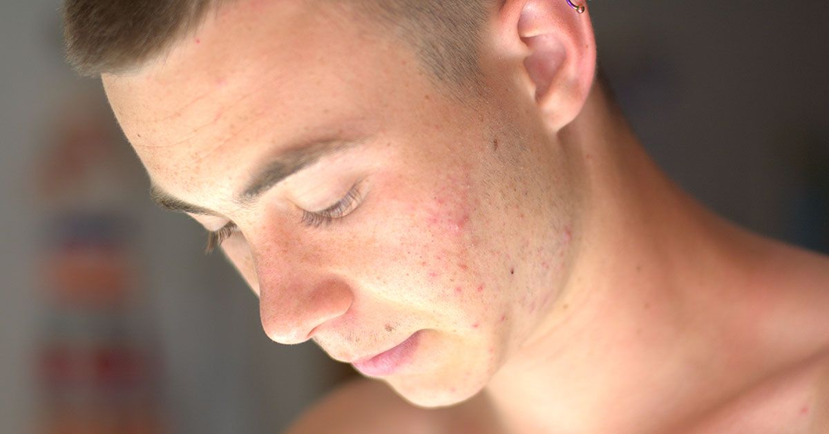 Tretinoin for Acne Usage Benefits Efficacy and Side Effects