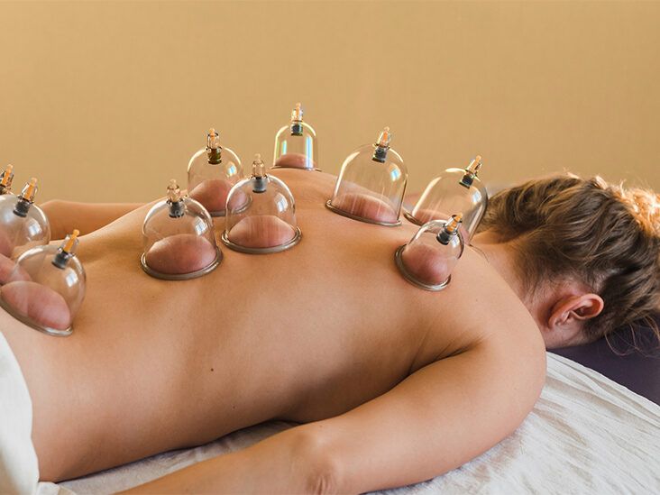 Cupping for Cellulite: Benefits, Side Effects, and How to Try It