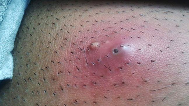 Infected open comedone (aka blackhead)