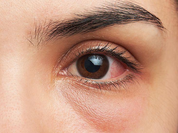How to get rid of a stye overnight