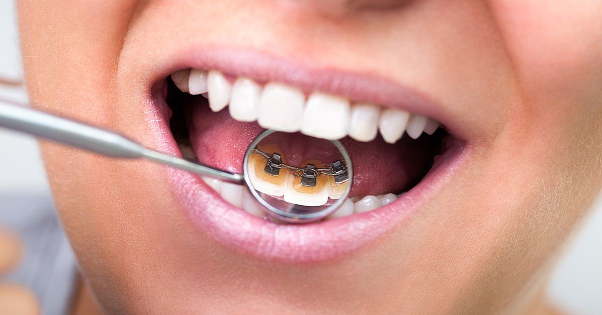 Clear vs Metal Braces: Pros & Cons, Costs & Prices