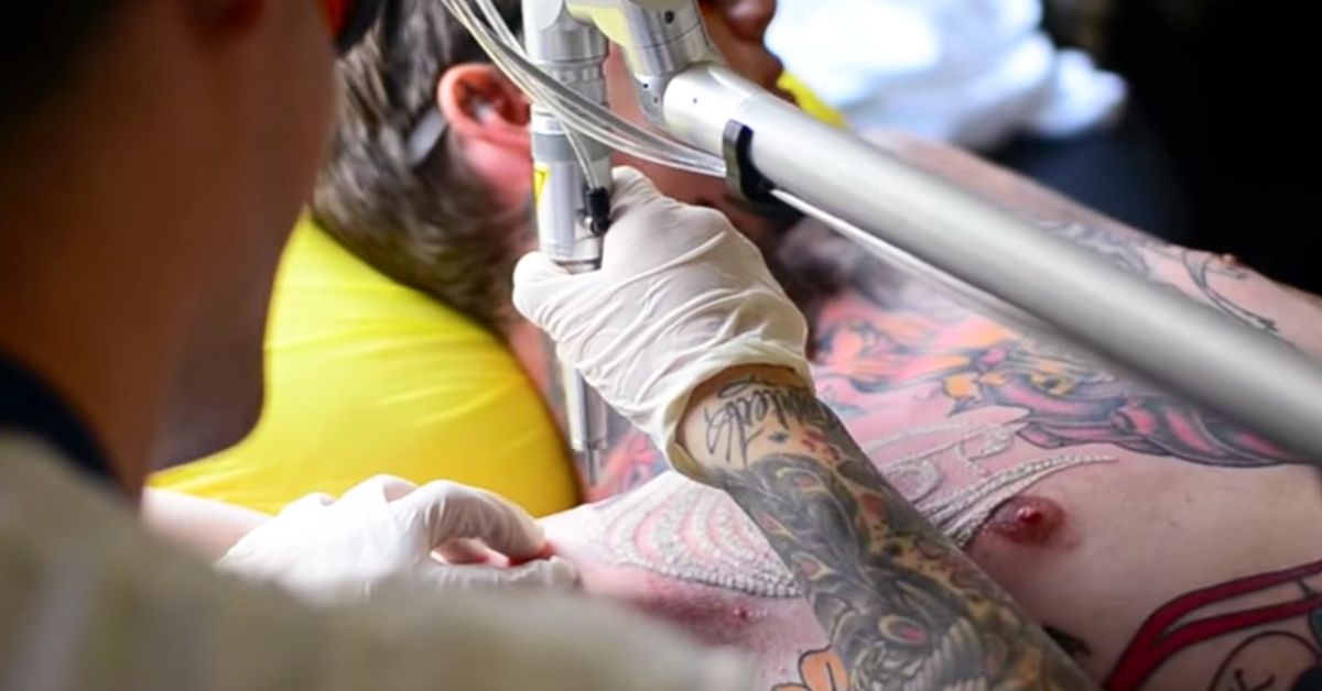 Laser Tattoo Removal in El Paso  Fewer Treatments Fast Results