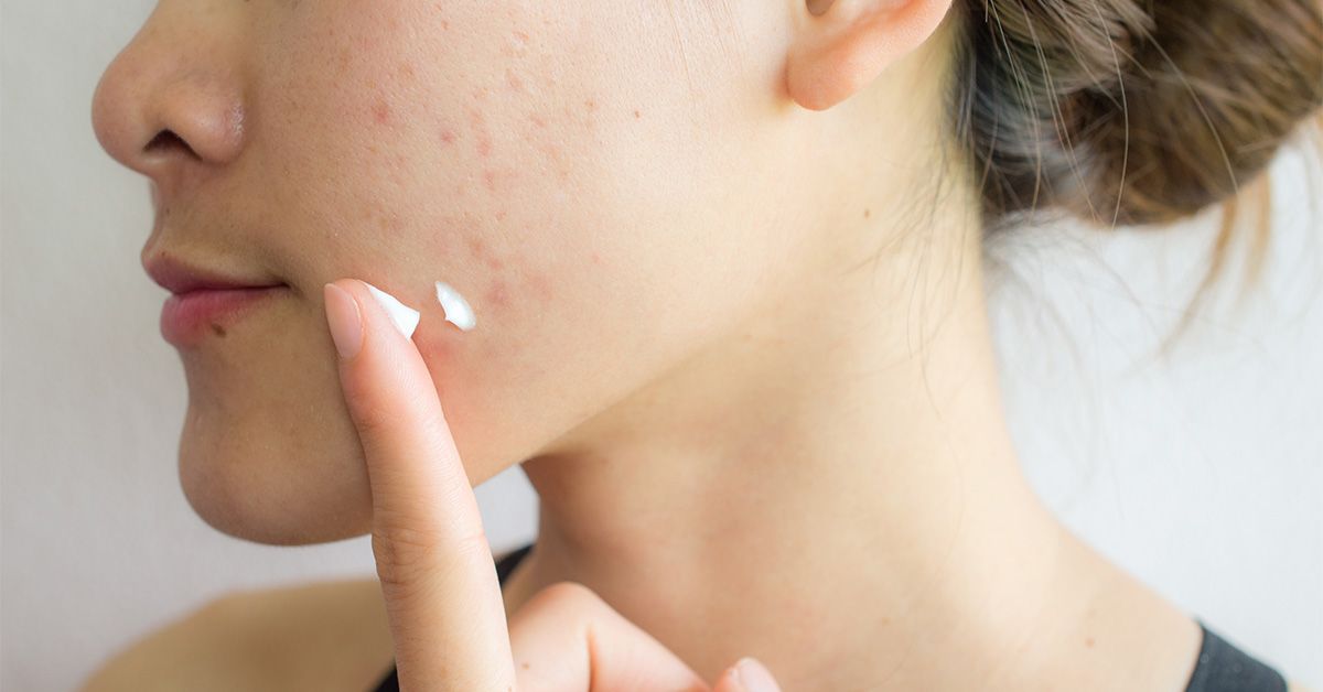 Types of Acne Scars: Pictures of Boxcar, Icepick, Rolling, and More