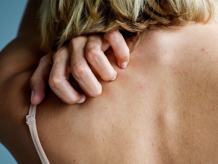 Causes and Remedies For Horrible Rash/ Reaction Post Breast
