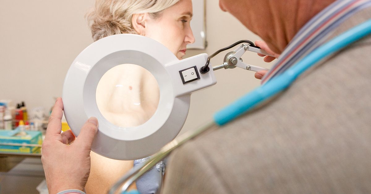 Photo: healthline.com Hausse des cas de mélanome au Colorado : le rôle critique de l'altitude et des UV