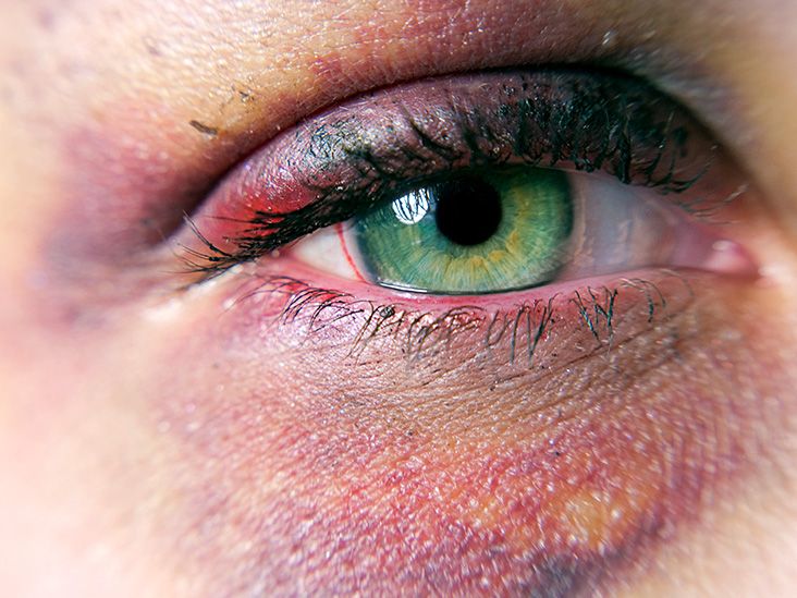 Black eye: What causes it and how to treat it