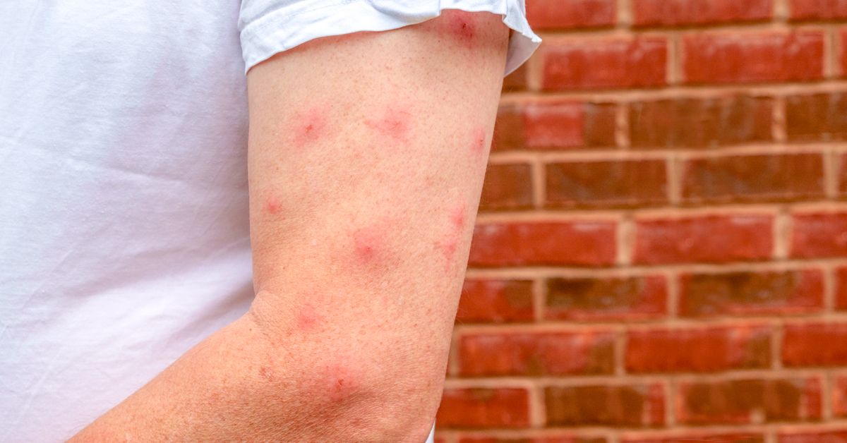 This Mosquito-Bite Tool Removes the Irritant, So It Doesn't Swell and Itch