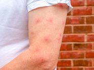 Mosquito Bite Blisters What Causes Them And How To Treat Them