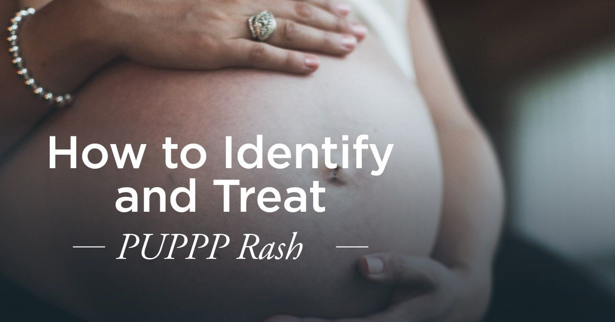 PUPPP Rash in Pregnancy: Symptoms, Causes, and Treatment