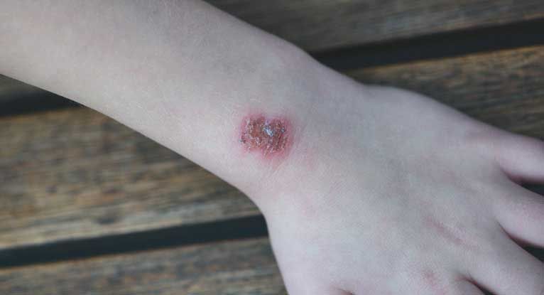 Staph Infection: Symptoms, Diagnosis, Treatment, and More