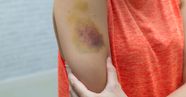 Ring Shaped Bruises Ring Shaped Bruises