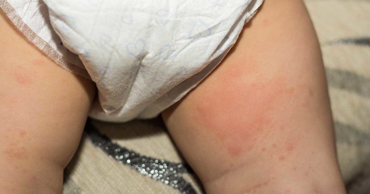 Raised Skin Bumps: Pictures, Symptoms, Causes, Treatments