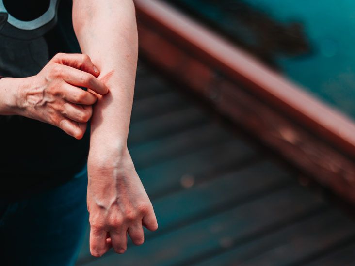 How Long Do the Symptoms of Eczema Last?