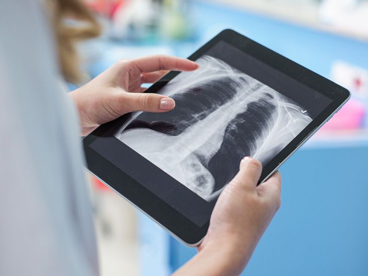 Costochondral Separation: Rib Separation Symptoms and Treatment