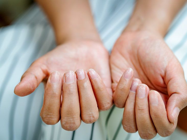 What to Know About Nail Psoriasis