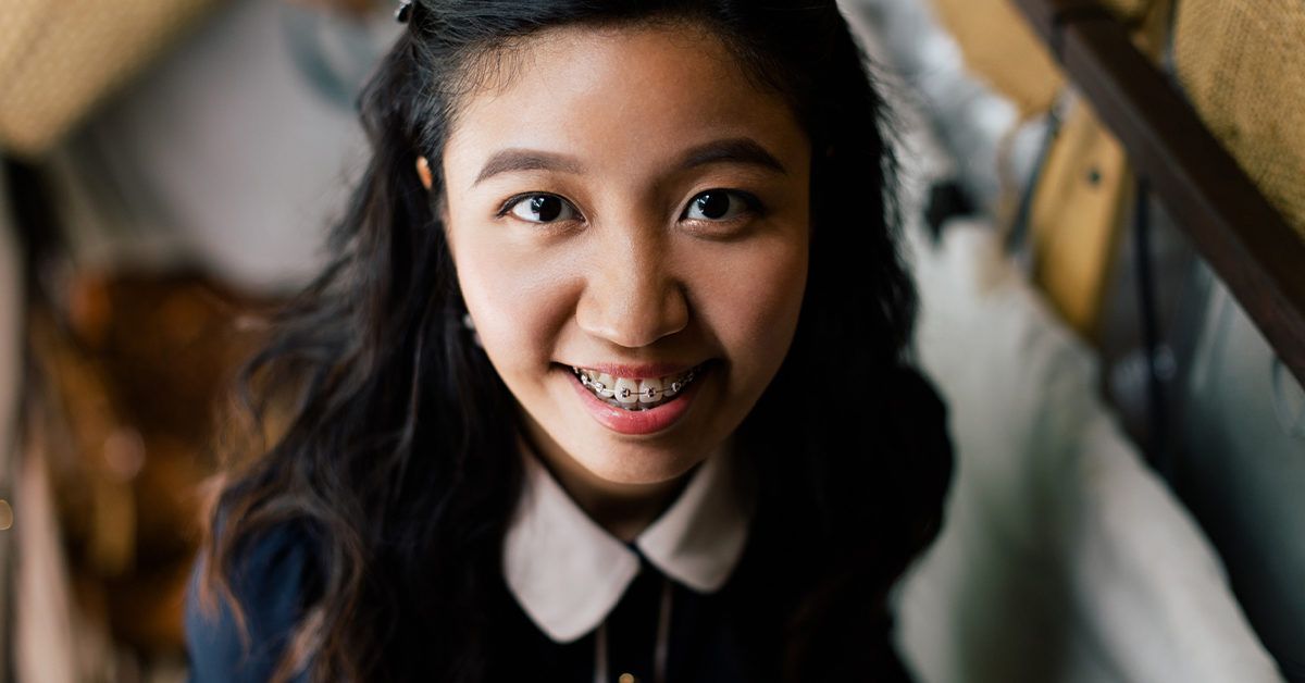 Overbite Braces Best Options, Alternative Treatments