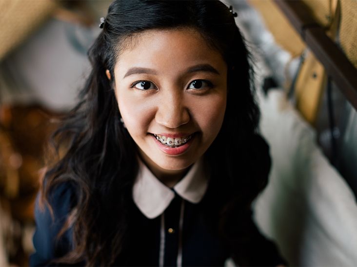 Overbite Braces Best Options, Alternative Treatments