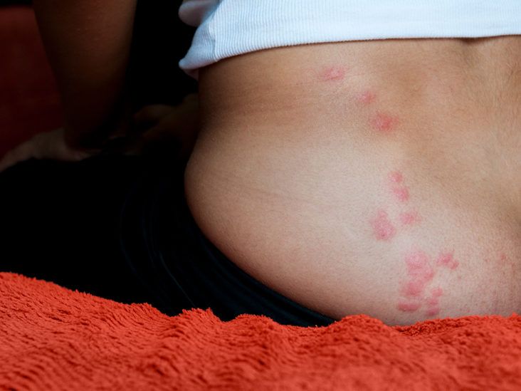 Flea Bites vs. Bedbug Bites: Which Is It?