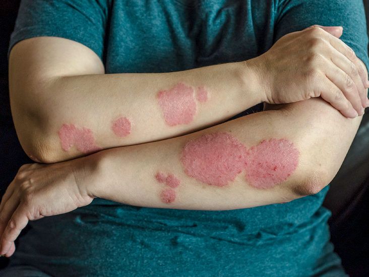 Why Isn't My Psoriasis Treatment Working? 12 Possible Causes