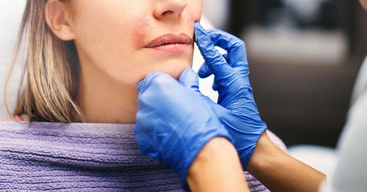 What Are Nasolabial Fold Fillers?