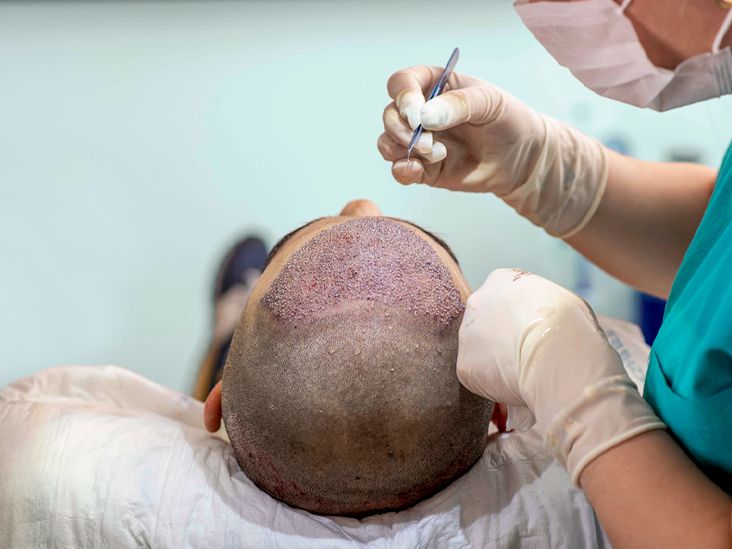 Brit, 26, left with horrific scars after botched £1,250 hair transplant in  Turkey | The US Sun