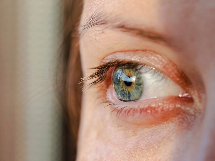 Mujer Con Ojos Secos Aplicando Lágrimas Artificiales En Invierno