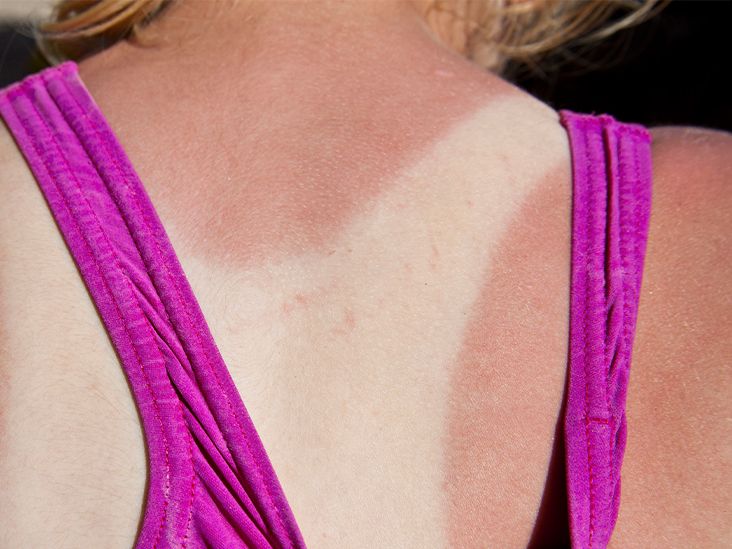 5 Research-Backed Foods to Help Heal a Sunburn