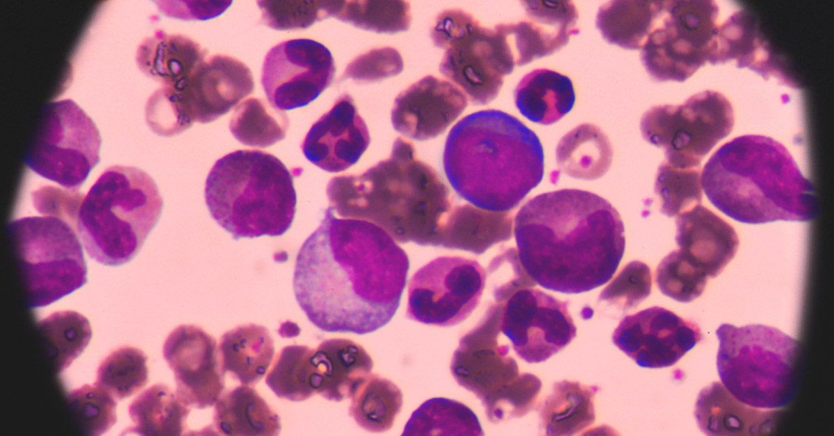 Flt3 Mutation And Aml Symptoms Testing And More Flt3 Mutation And Aml Symptoms Testing And More