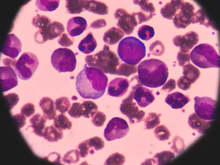 People With Acute Myeloid Leukemia Acute Myeloid Leukemia With