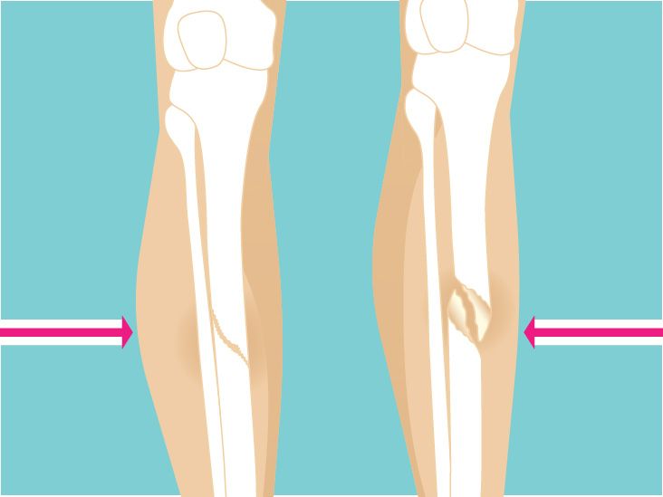 Spiral Fracture: Healing Time, Tibia, and Fibula