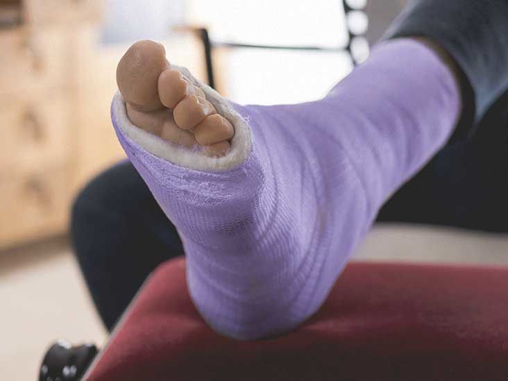 Ankle Dislocation: Treatment, Rehab & Recovery Time - Lesson