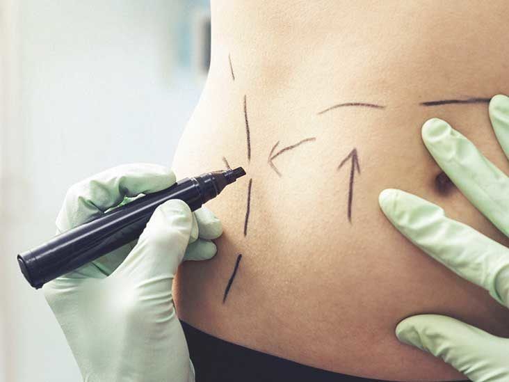 Liposuction vs. Microcannula Tumescent Liposuction: What's the