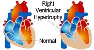 Cor Pulmonale: Causes, Symptoms, and Diagnosis