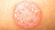 Ringworm (Tinea Corporis) Condition, Treatments and Pictures for Teens -  Skinsight