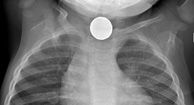 Swallowed (or Inhaled) Foreign Object: Risk Factors And Treatment