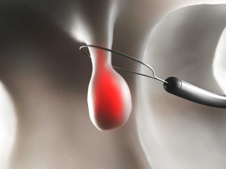 Polypectomy: Surgery Procedure and Recovery