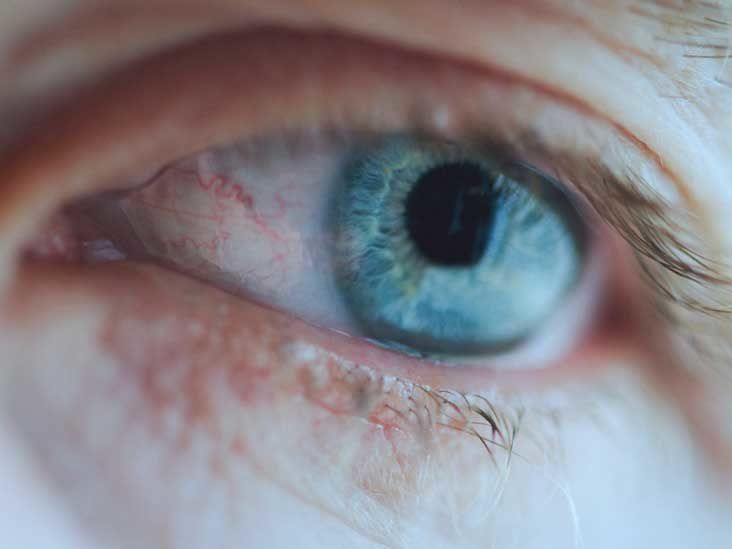 purple eye syndrome