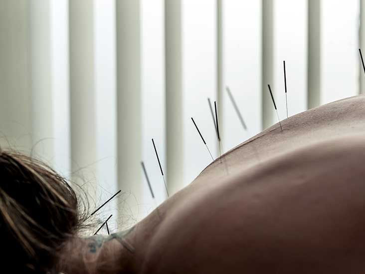 Fertility Acupuncture, London