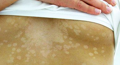 Gray Skin Causes and Treatment