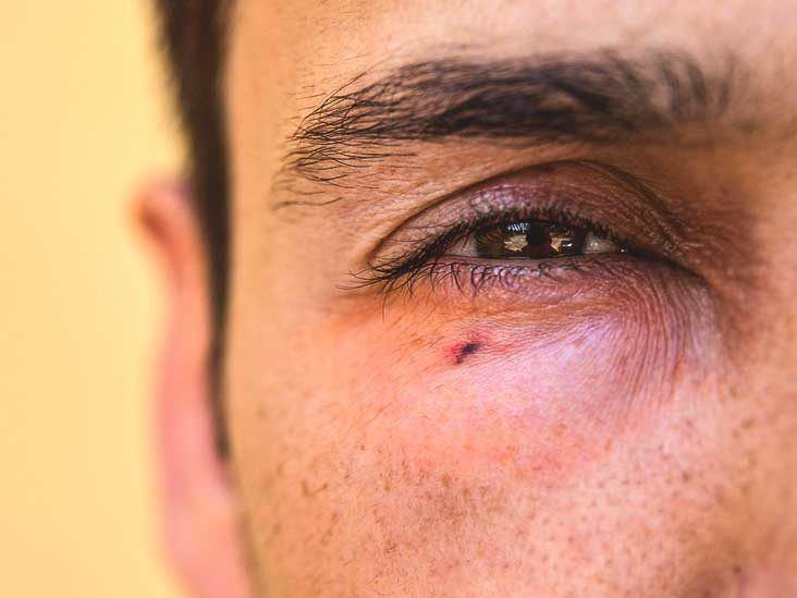 Black Eye (periorbital haematoma): Causes, Symptoms, Risk Factor and  Treatment