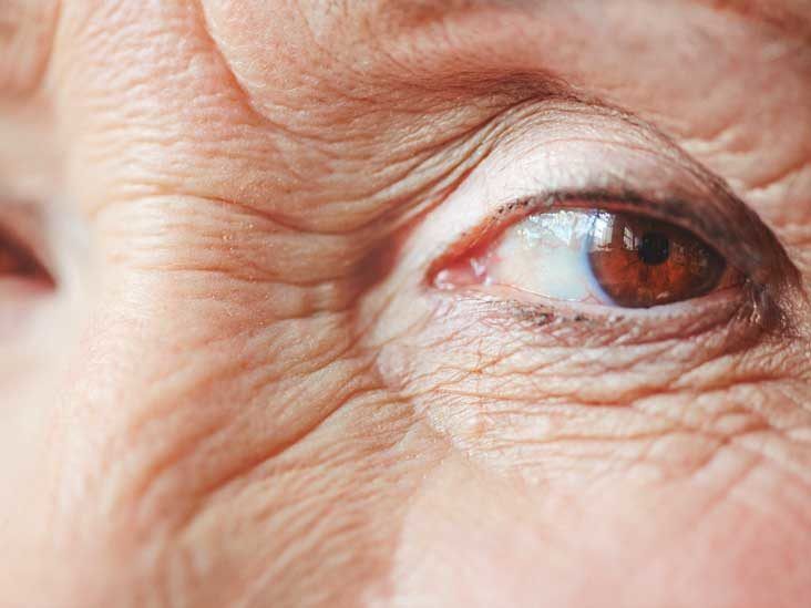 Blue Ring Around Eye: Pictures, Causes & Treatment