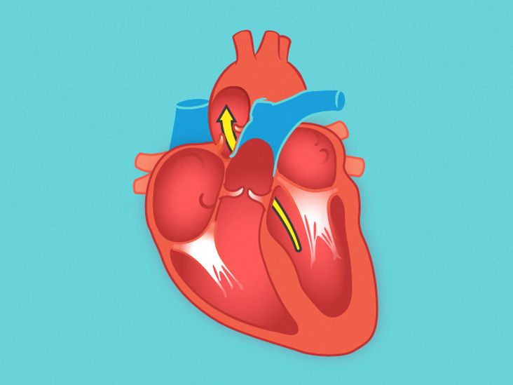 End-Diastolic Volume: What It Is, Effects, and Conditions