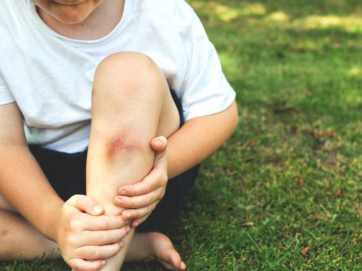 How to Care for Your Child with a Sprain or Soft Tissue Injury