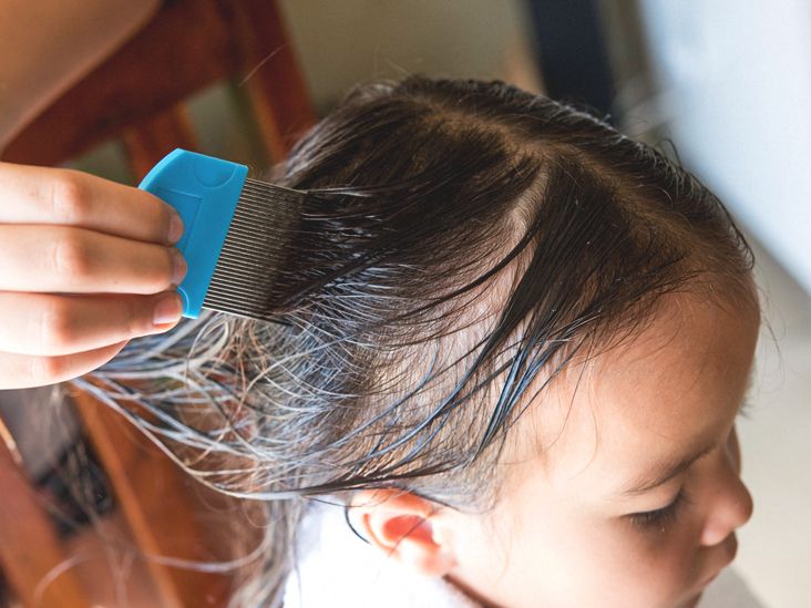 DrugResistant Super Lice Symptoms, Treatment, and Prevention