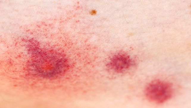 Insect Sting Allergy Basics: What Are Allergies?