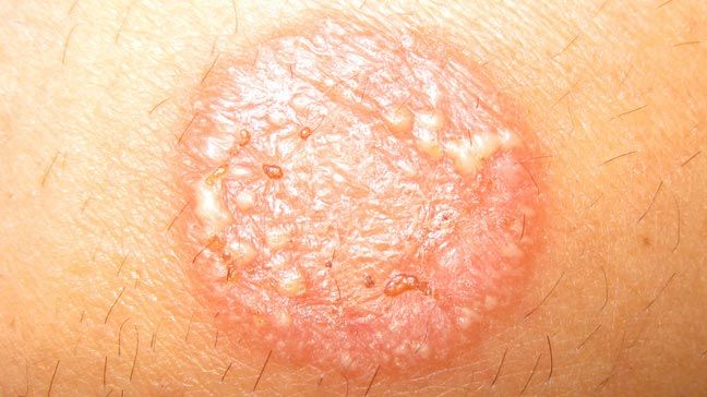 Ringworm vs. Eczema: Symptoms, Causes, Treatments