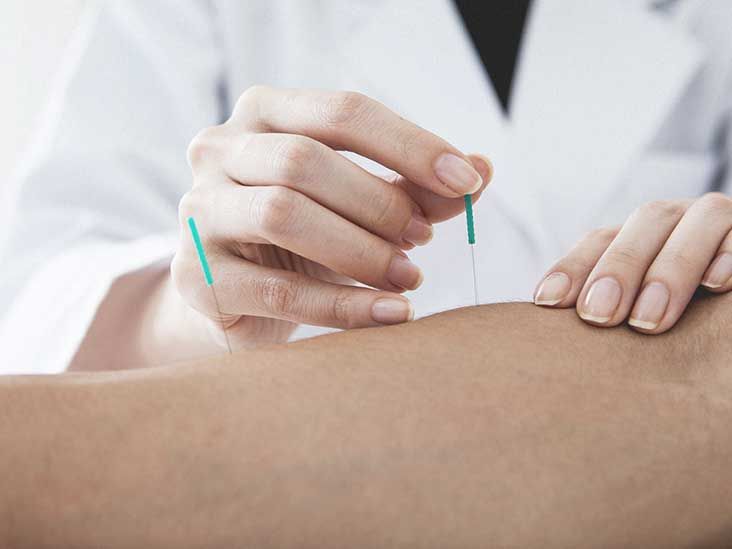 Dry Needling vs. Acupuncture